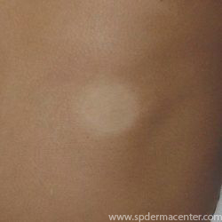 Vitiligo-Before